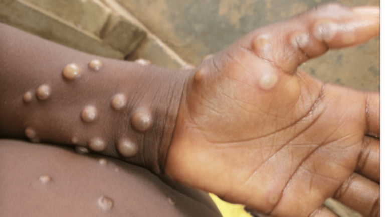 Le Ghana confirme un nouveau cas de mpox